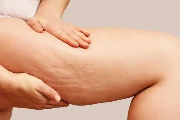 Image of woman showing leg with cellulite Oxshott