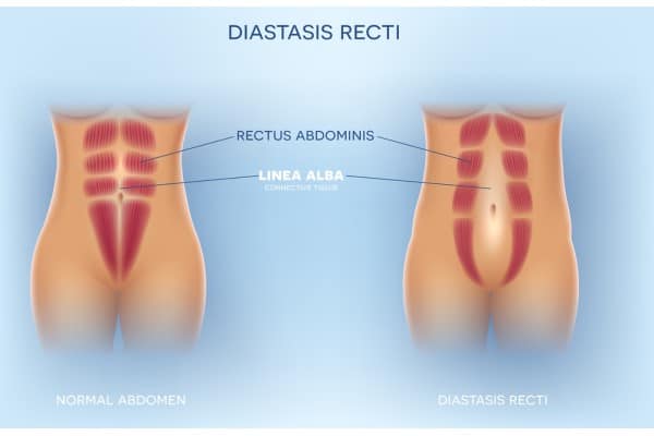 What Non-Surgical Options Are Available for Diastasis Recti Oxshott?