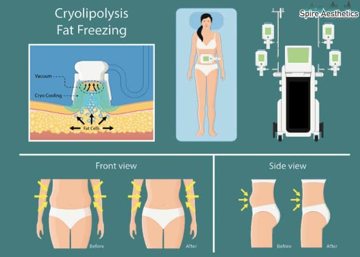Image of diet and fat freezing combined for best results for Spire Aesthetics Oxshott