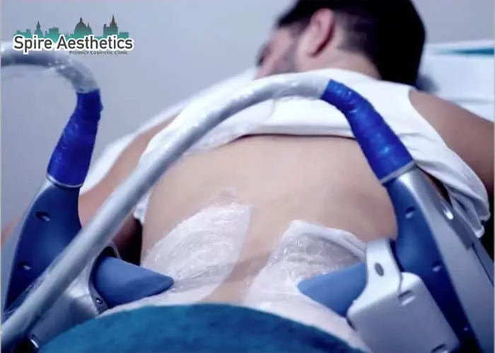 Man having fat freezing treatment done on love handles before a competitions Oxshott to create a sculpted look.