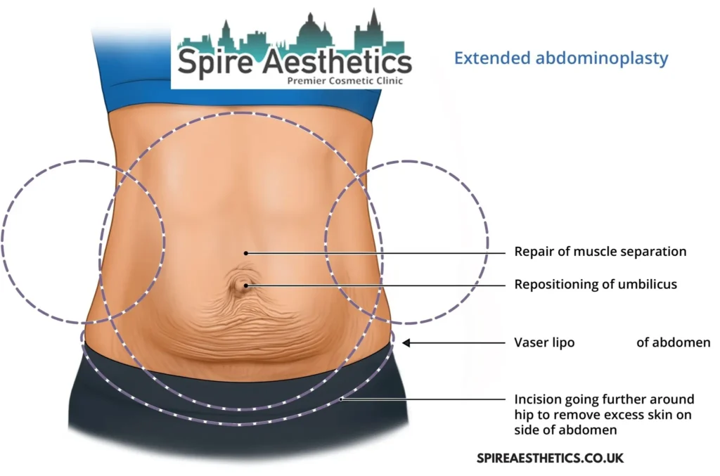 Understanding Loose Skin After Gastric Band Oxshott Surgery and HIFU Treatment 