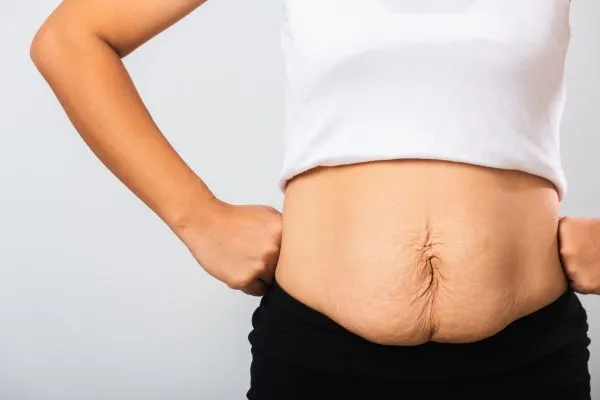 Image of a woman's stomach after weight loss with sagging skin following a gastric band Oxshott