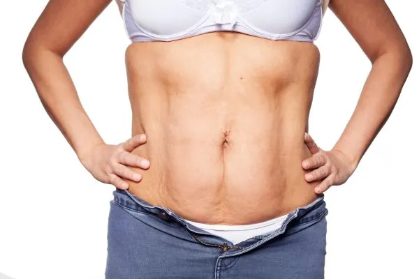 sagging skin on woman's stomach after weight loss injections Oxshott