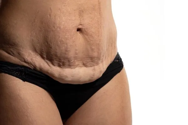 Image of womans stomach after weight loss injections Oxshott showing saggy skin