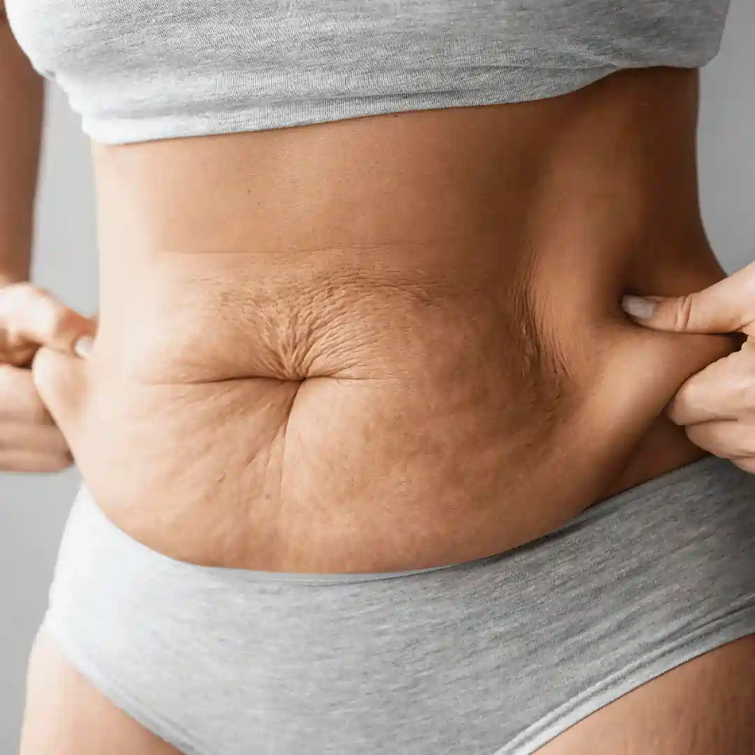 Is It Normal to Have Loose Skin After Pregnancy Oxshott?