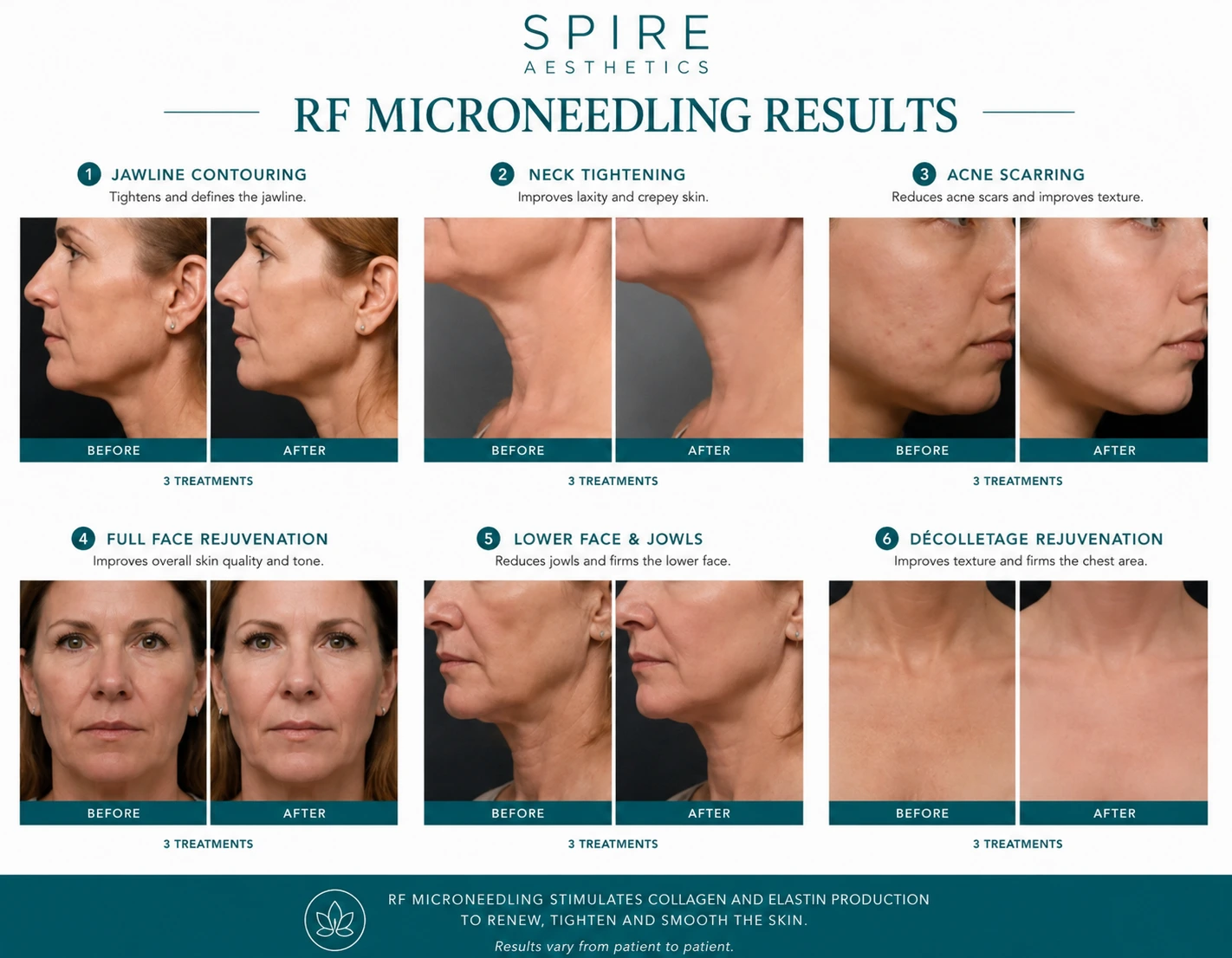 RF Microneedling Skin tightening Oxshott results