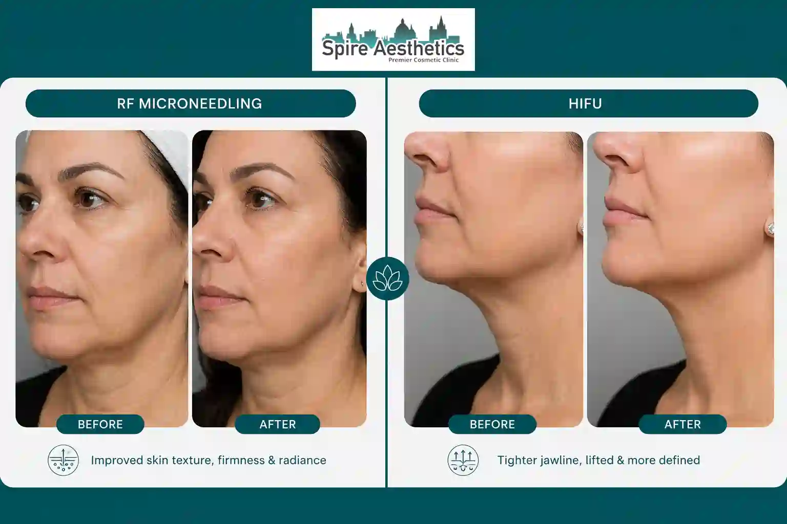 Can RF Microneedling and HIFU Be Combined Oxshott?