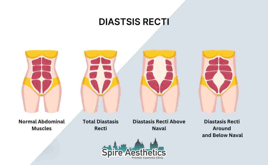 Is Non-Surgical Diastasis Recti Treatment Right for You? Common Concerns Answered Oxshott